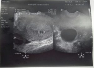 Беременность 4-5 недель не видно эмбриона