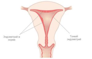 Беременность на тонком эндометрии