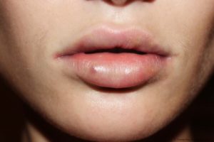 Фиброз после введения филлера в губы