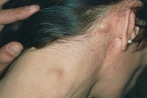Гиперплазия лимфоузлов шеи