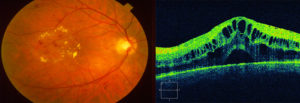 ОСТ макулы и сетчатки