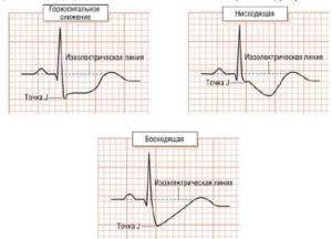 Что значит снижение сегмента ST