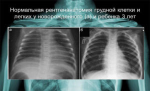 Рентген органов грудной клетки: расшифровка
