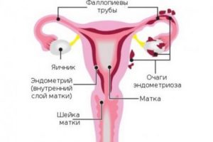 Беременность на тонком эндометрии