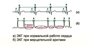 Мерцательная аритмия вагусного типа