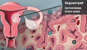 Беременность на тонком эндометрии