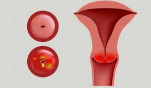 Воспаление шейки матки
