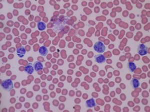 Атипичные лимфоциты в крови
