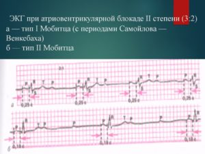 СССУ, БЛОКАДА самойлова венкебаха