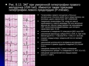 Изменения миокарда левого желудочка