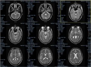 Расшифровка МРТ головного мозга