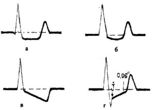 Смещение сегмента ST