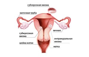 Полип эндометрия и миома