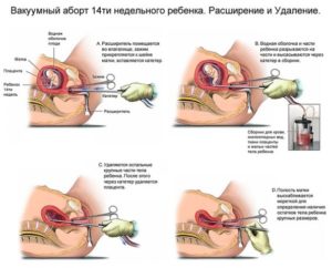 Кровотечение после вакуумной аспирации