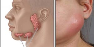 Небольшая опухоль вокруг правого уха и возле челюсти