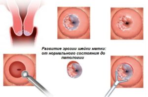 Выделения после прижигания эрозии шейки матки