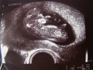 Планирование после двух неразвивающихся беременностей