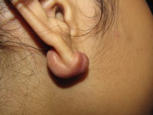 Плотное образование за мочкой уха