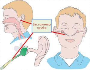 Заложенность уха после синусита