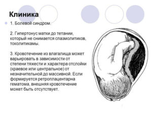 Ретрохориальная гематома и выделения