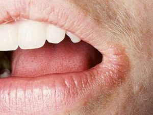 Жжение губ и кончика языка, трещины в уголках губ