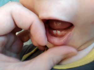Первые молочные зубы лезут криво