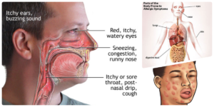 Чешутся глаза, слезятся, нос, уши, горло, нёбо