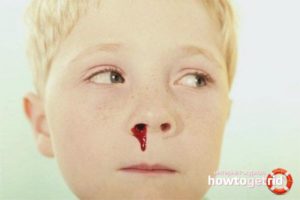 Кровь из носа после удара затылком