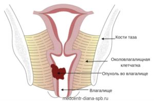 Опух вход во влагалище