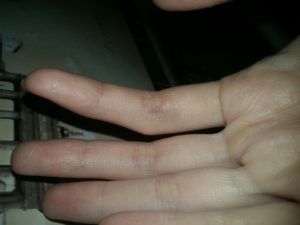 Образование на сгибе пальца под кожей, болит при нажатии