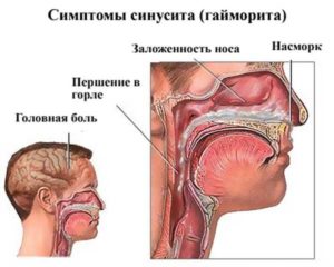 Заложен нос и болит горло