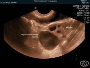 Параовариальная киста во время беременности