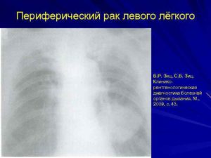 Периферический c-r левого легкого