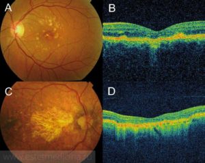 ОСТ макулы и сетчатки