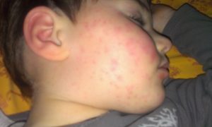 Аллергия и лимфоузел
