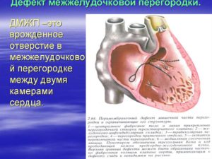 Дефект межжелудочковой перегородки у плода