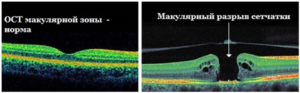 ОСТ макулы и сетчатки