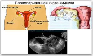 Параовариальная киста во время беременности