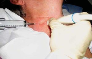 Боль в глотке после биопсии щитовидной железы