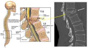 Компрессионный перелом позвоночника L1