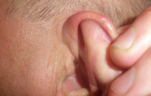 Уплотнение на ушной раковине