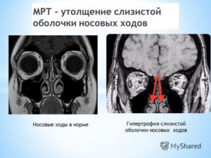Утолщение слизистой верхнечелюстной на МРТ