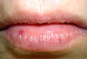 Мелкие красные точки на внутренней стороне губы