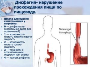 Пища не проходит по пищеводу