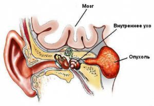 Невринома слухового нерва