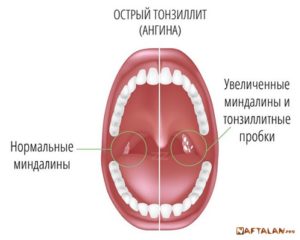 Увеличена миндалина с правой стороны