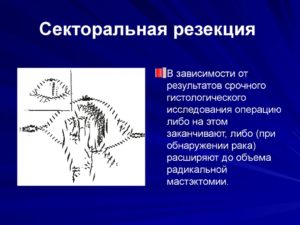 Последствия секторальной резекции