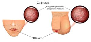 Сифилис или нет как распознать