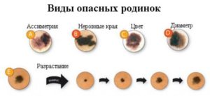 Анализы для удаления родинки