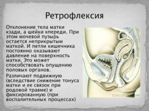 Что означает ретрофлексия матки? И смогу ли я забеременеть?